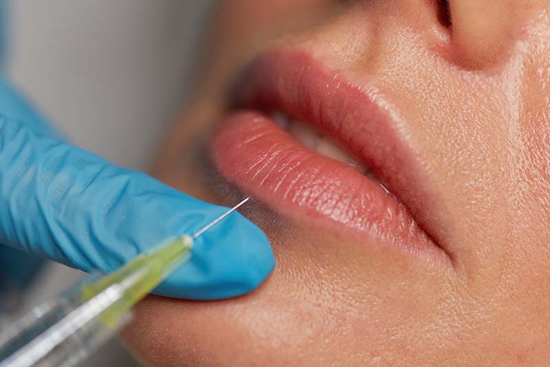 McAllen Dermal Fillers Lip Fillers and more